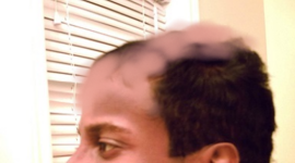 boqhairloss3224.png