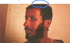 boqbeardhairloss (1).png
