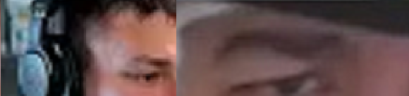 droopy eyelid.png