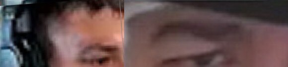 droopy eyelid (1) (1) (1).jpg